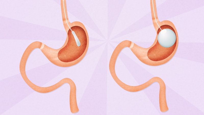 Pharmacotherapy Boosts Weight Loss Effects of Intragastric Balloons