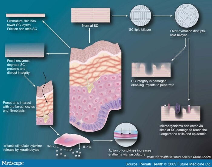 Recent Advances in Diaper Dermatitis Etiology and Treatment