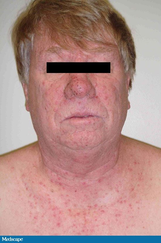 Acne In A Patient With Pancreatic Cancer 5693