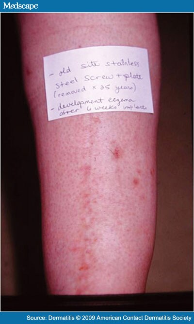 Allergy to surgical implants image