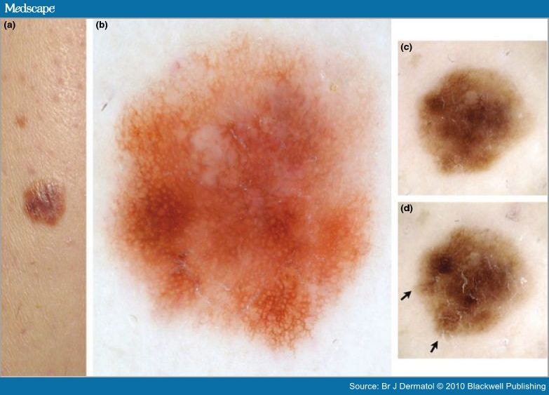 slow-growing-melanoma-a-dermoscopy-follow-up-study