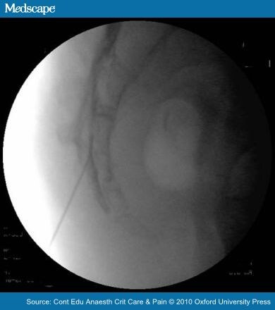Caudal epidural steroid injection with fluoroscopy