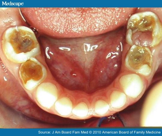 cure tooth decay pdf full