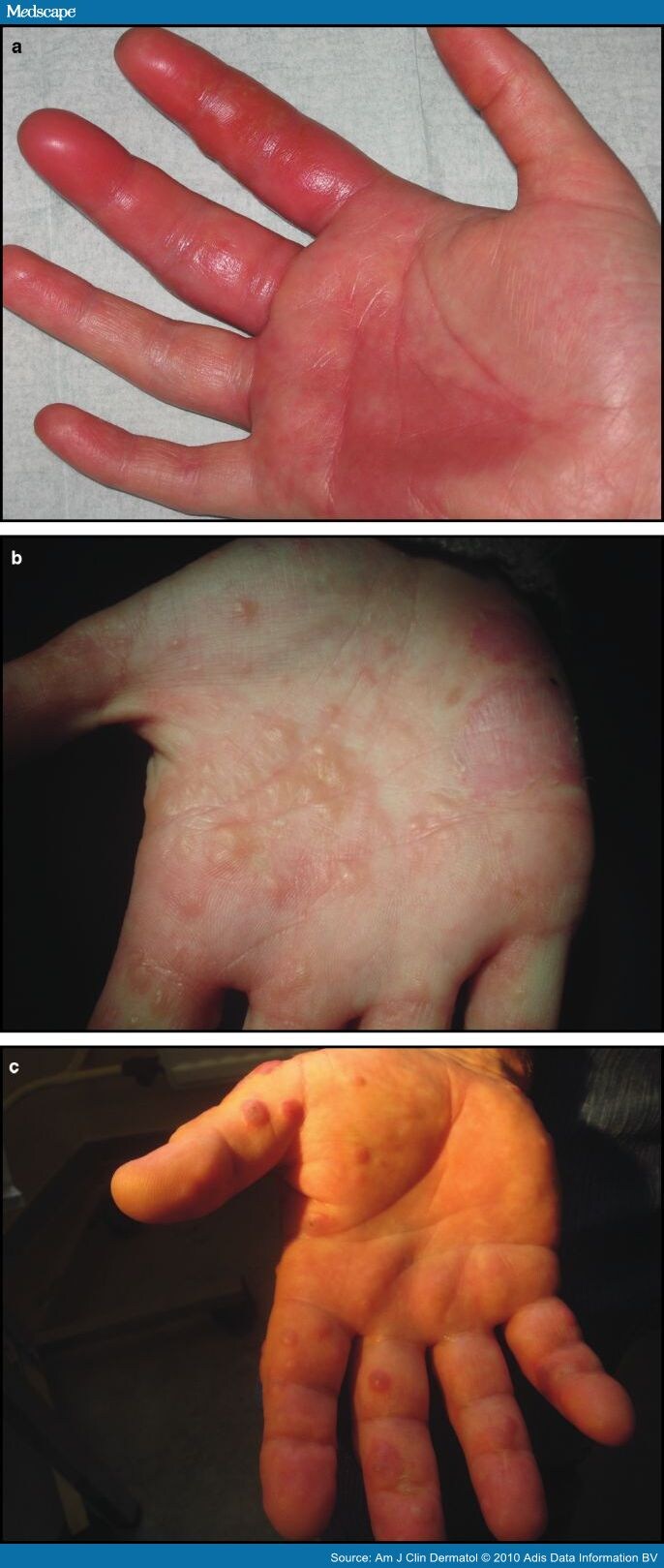 Pompholyx Clinical Features, Differential Diagnosis, and Management