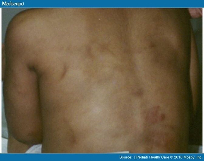 Bruises in Children: Normal or Child Abuse?