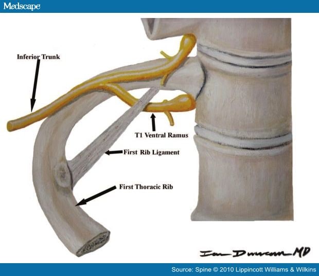 Thoracic Spinal Ligament Sprain