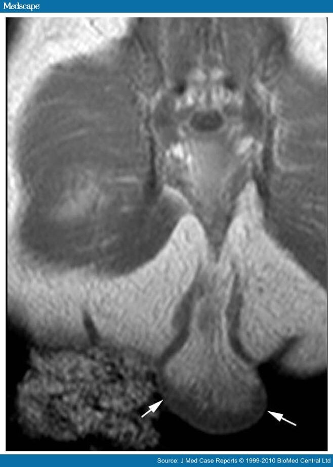 Imperforate Anus With a Rectovestibular Fistula and Pseudotail