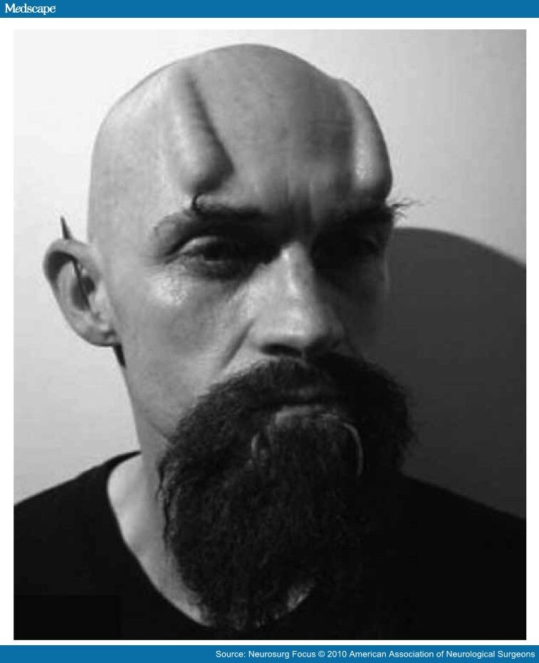 Modern Induced Skull Deformity in Adults