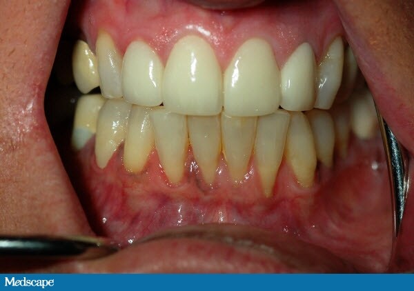 brown spots on teeth near gums