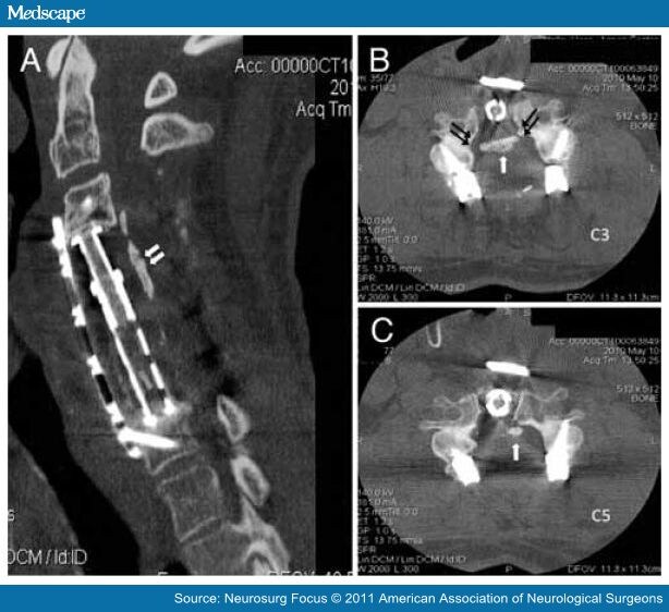 Pathogenesis and Current Surgical Approaches to OPLL