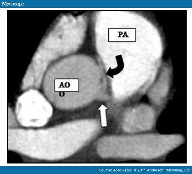 Coronary Artery Anomalies On CT Angiography