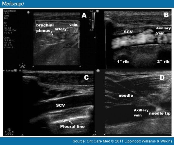 Ultrasound-Guided Subclavian Vein Cannulation Vs Landmark