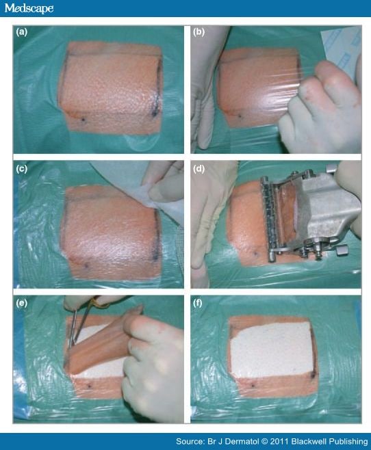 An Easy and Fast Technique for SplitThickness Skin Grafting
