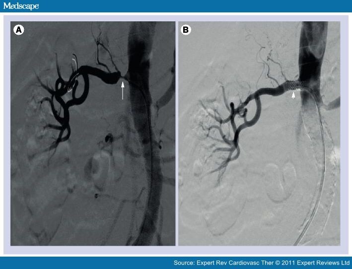 Atherosclerotic Renal Artery Stenosis and Renal Artery Stenting