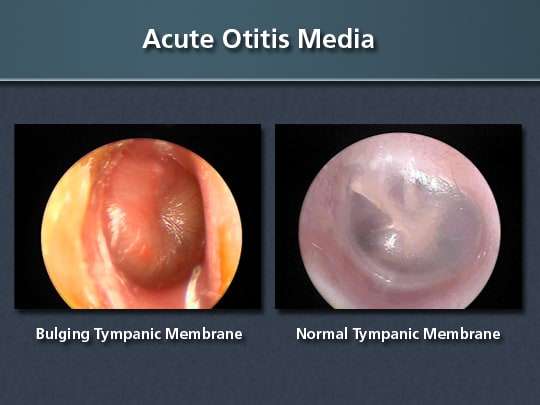Acute Otitis Media: Clinical Guidance for Diagnosis and Treatment