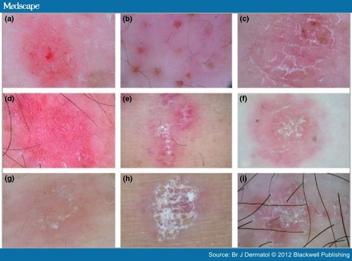 Dermoscopy For Diagnosis Of Inflammatory Skin Diseases