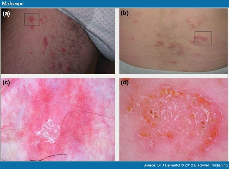 Dermoscopy For Diagnosis Of Inflammatory Skin Diseases