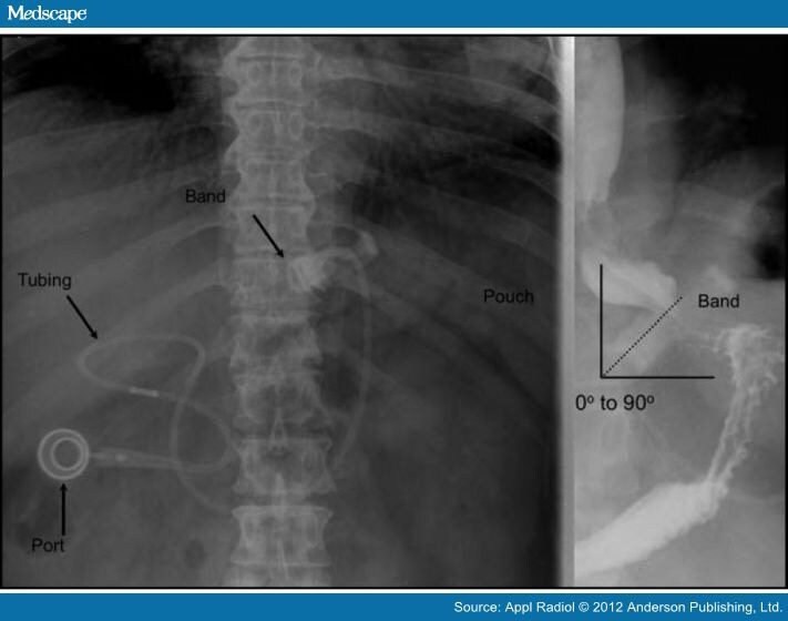 Imaging Findings in Bariatric Surgery
