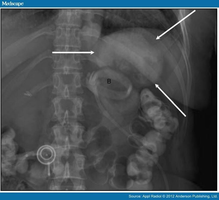 Imaging Findings in Bariatric Surgery
