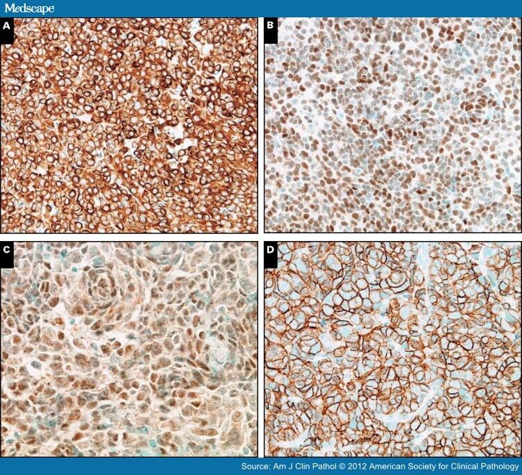 Thymic Carcinoma, Part 1 Immunohistochemical Study