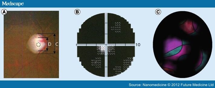 Progress Towards Noninvasive Gene Therapy Of Glaucoma