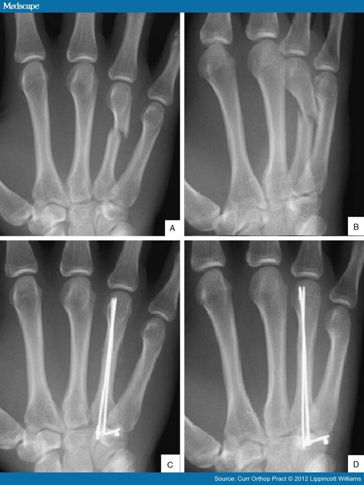 icd 10 code for nondisplaced fracture of fifth metacarpal left hand