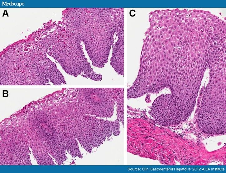 Diagnosis And Management Of Eosinophilic Esophagitis