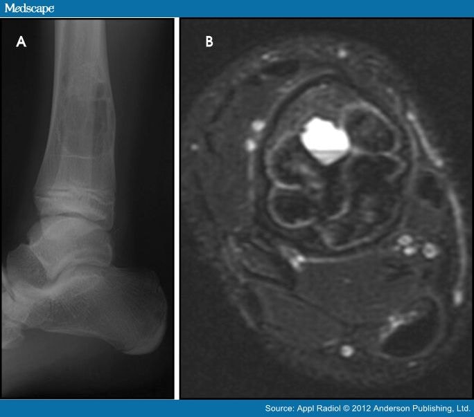 Bone Tumors and Tumor-like Conditions of Bone