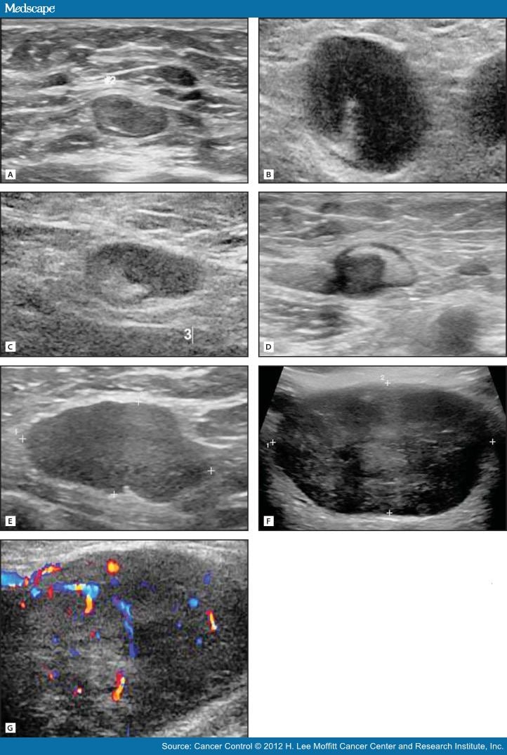 Axillary Staging Prior To Neoadjuvant Chemotherapy