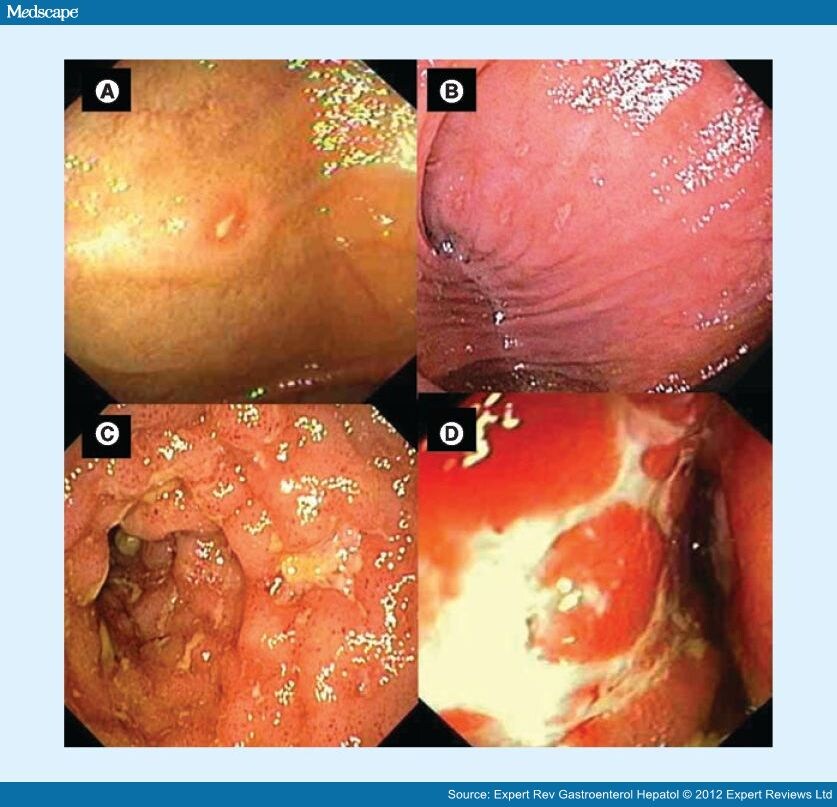 The Evolving Management of Postoperative Crohn's Disease