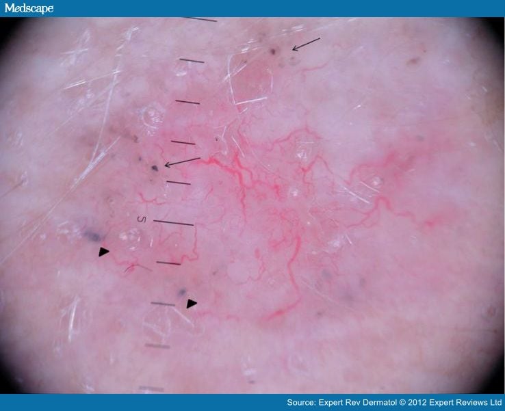 Dermoscopy Distinguishing Malignant Tumors From Benign