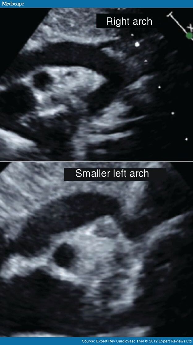 right aortic arch with mirror image branching