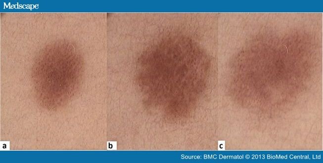 Tips And Tricks In The Dermoscopy Of Pigmented Lesions Page