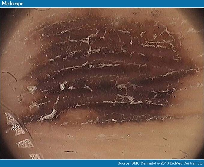 Tips And Tricks In The Dermoscopy Of Pigmented Lesions Page