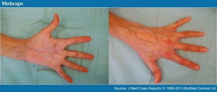 A Woman Presenting With A Synovial Sarcoma Of The Hand