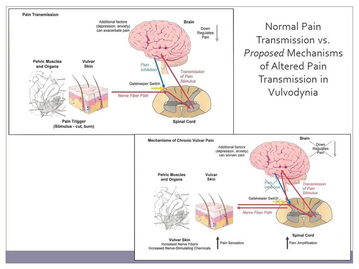 Vulvodynia An Underrecognized Pain Disorder Affecting 1 in 4 Women