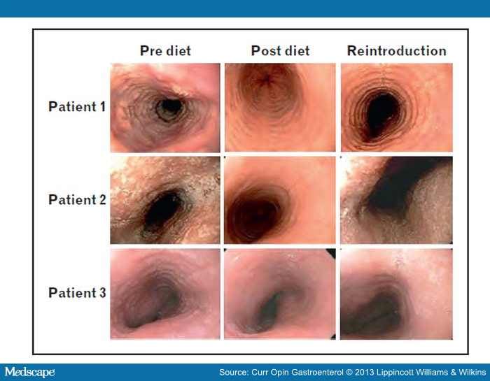 Diet Therapy For Eosinophilic Esophagitis 0844