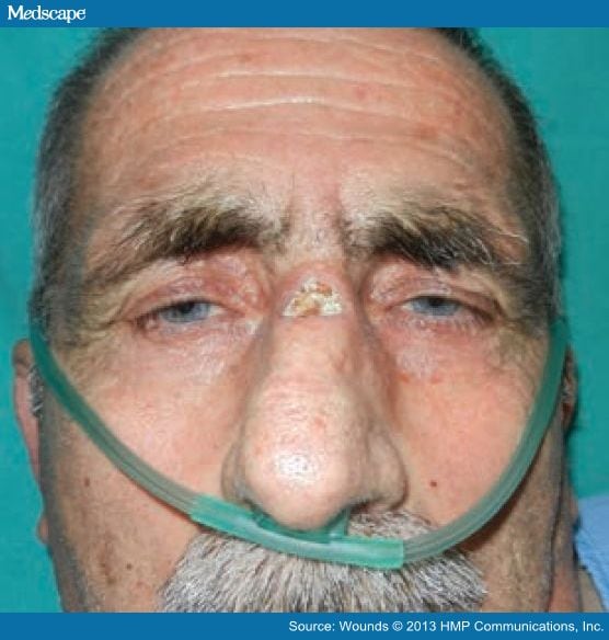 An Unusual Location for a Pressure Ulcer