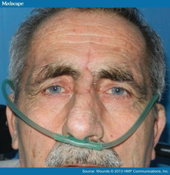 An Unusual Location for a Pressure Ulcer