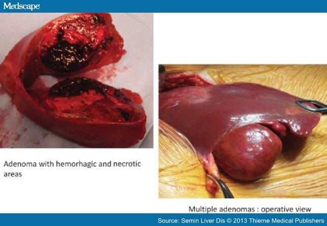 Diagnosis and Management of Benign Liver Tumors