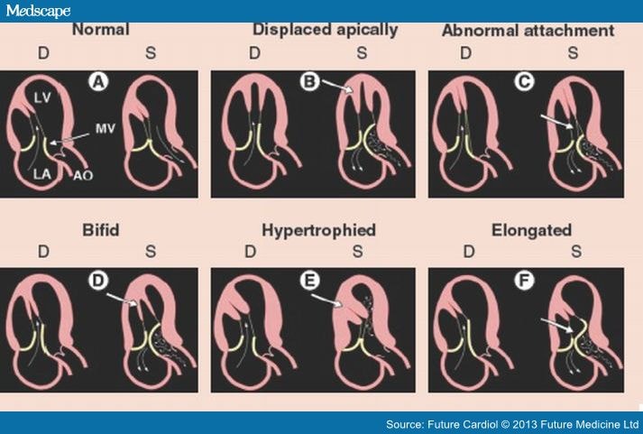 Advances Of Cardiovascular Mri In Hypertrophic Cardiomyopathy Page