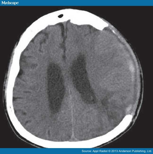 Acute Paradoxical Brain Herniation After Decompressiv Vrogue Co