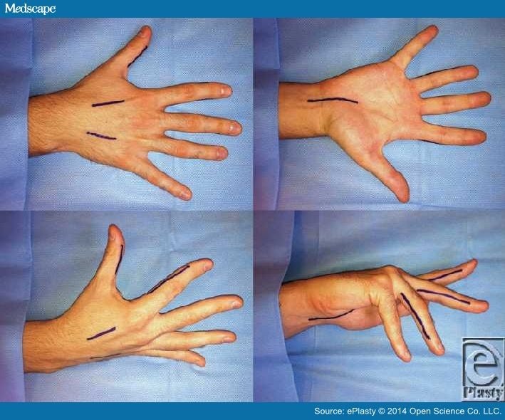 compartment-syndrome-of-the-hand