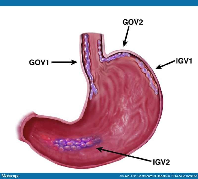 Management of Gastric Varices