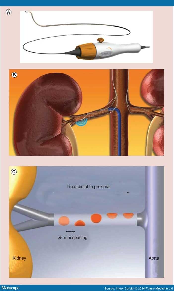 Renal Sympathetic Denervation Indications Contemporary Devices Page