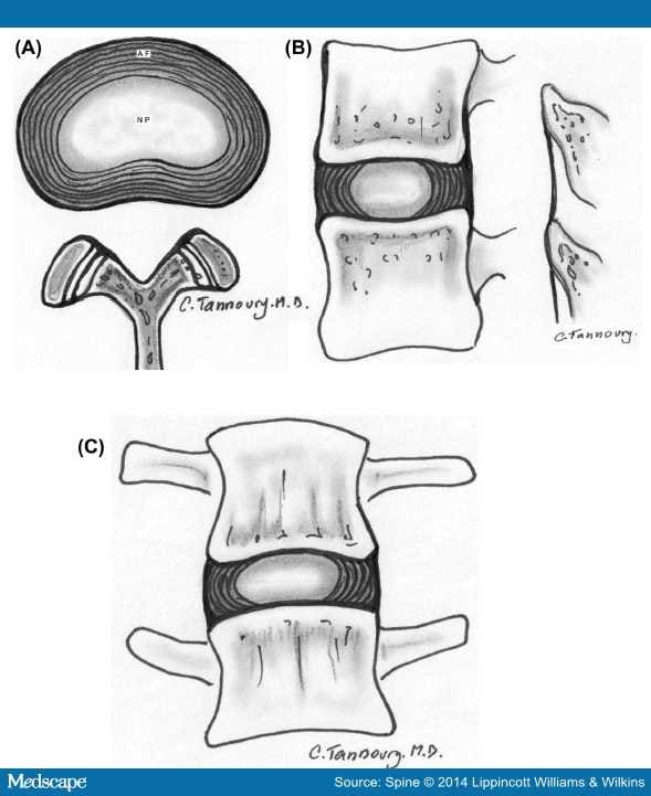 Lumbar Disc Nomenclature: Version 2.0