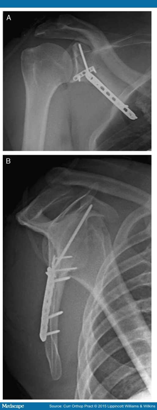 Scapular Fractures Diagnosis and Treatment Plan