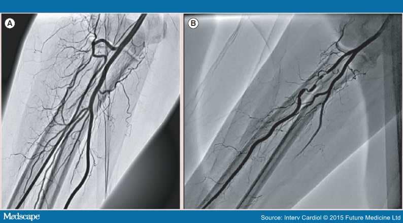 Transradial Carotid Artery Stenting Page