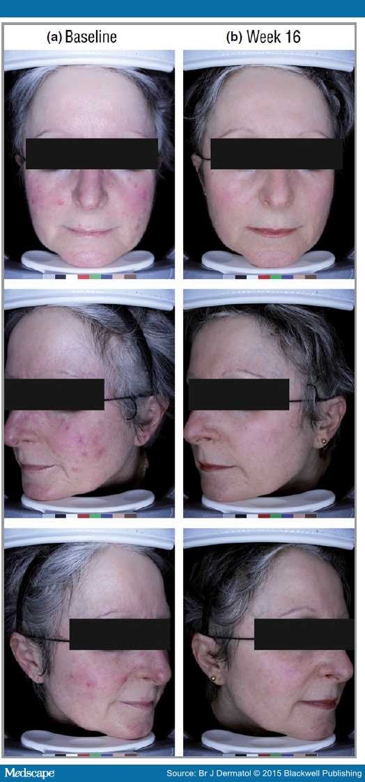 Ivermectin Cream vs Metronidazole Cream in Treating Rosacea