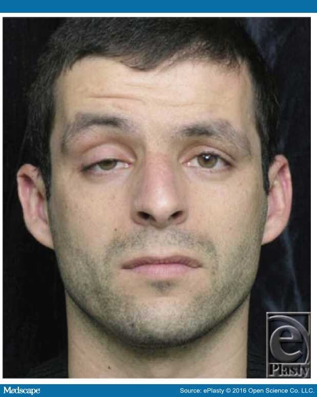 Frontalis Sling for the Treatment of Congenital Ptosis